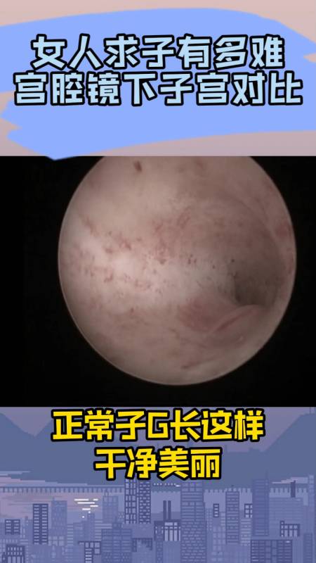 女人求子有多难宫腔镜下子宫对比图
