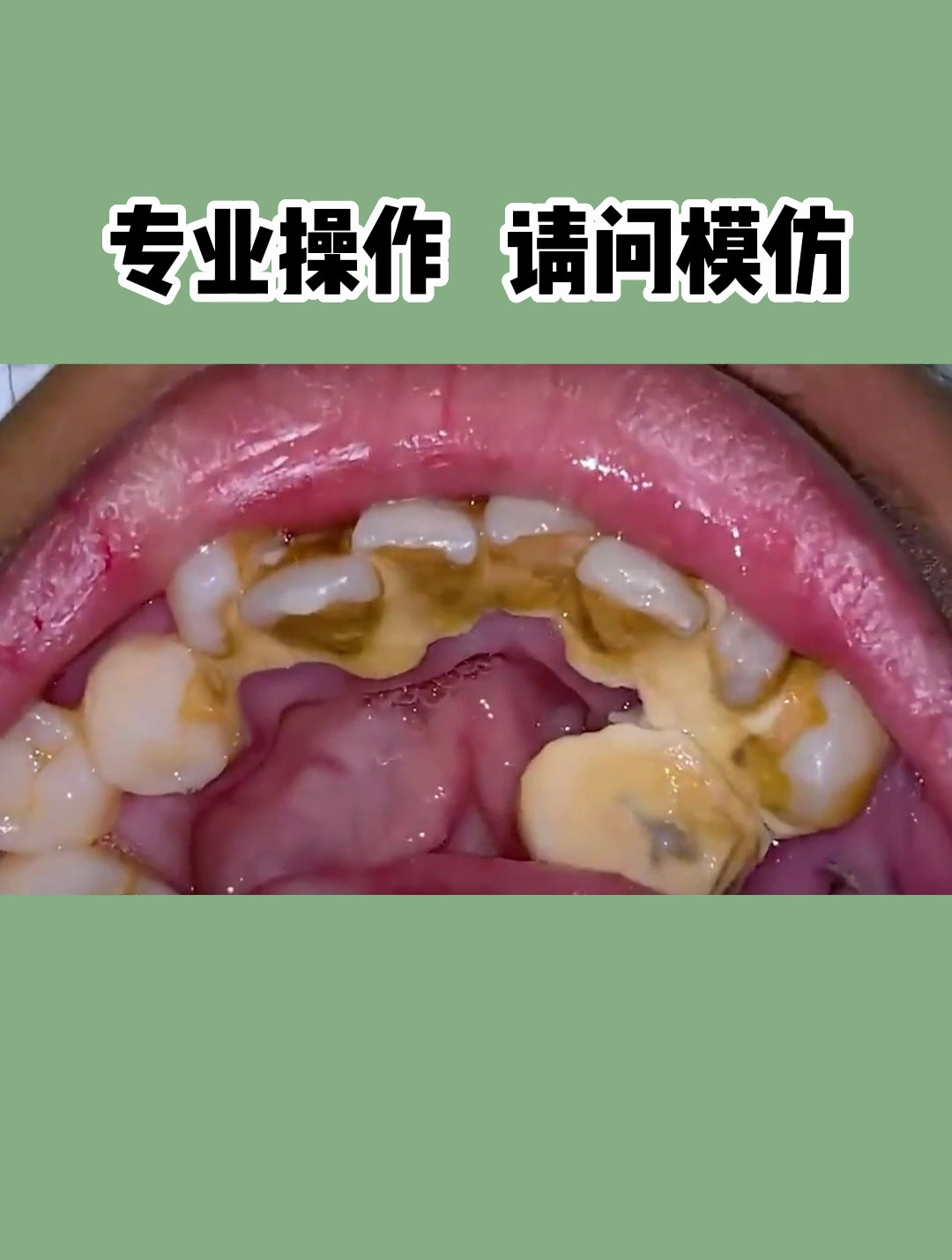 实拍洗牙全过程,大块大块的牙结石脱落,看着真爽!