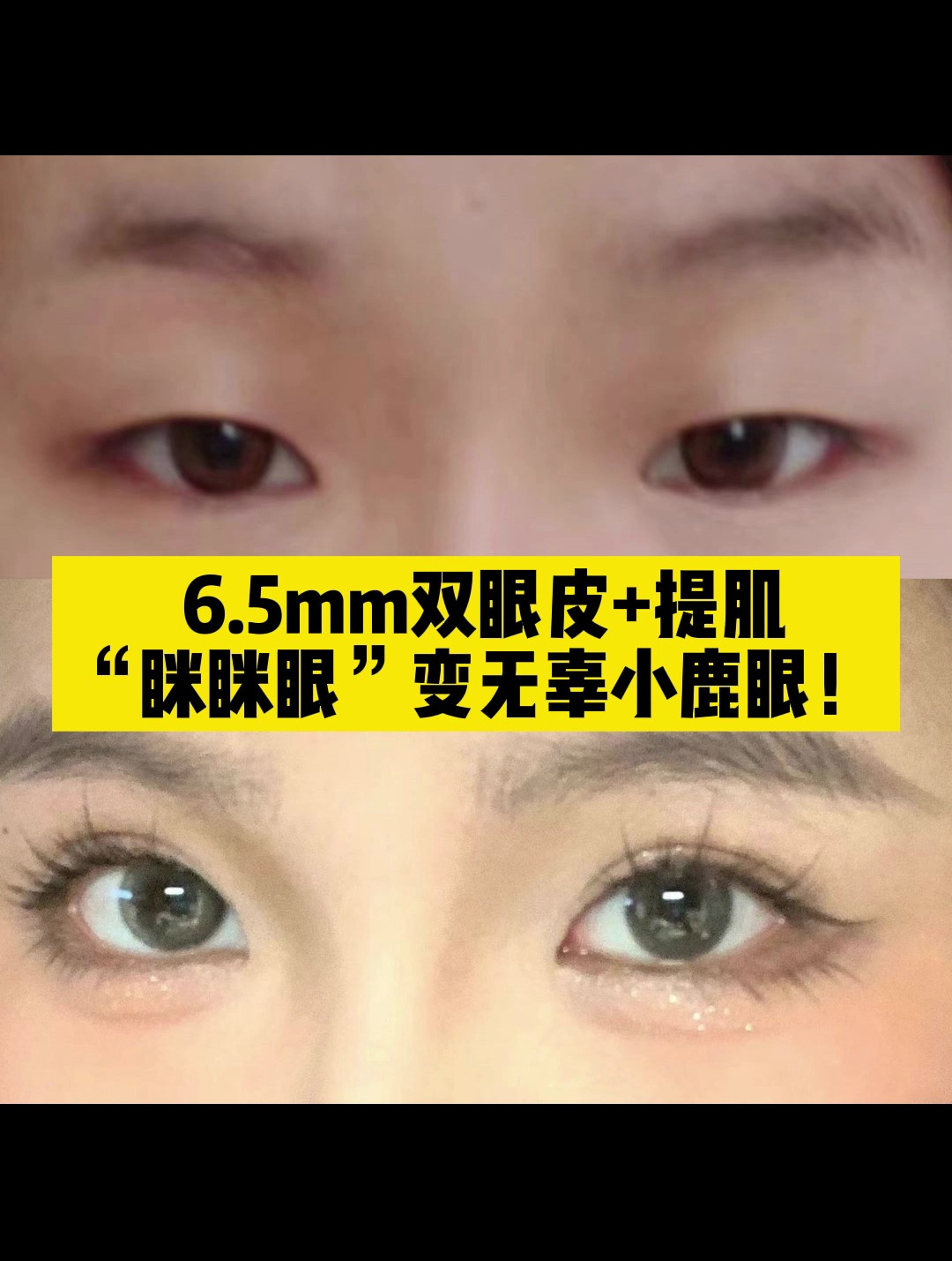 女大学生从小被说眯眯眼双眼皮提肌后变无辜小鹿眼