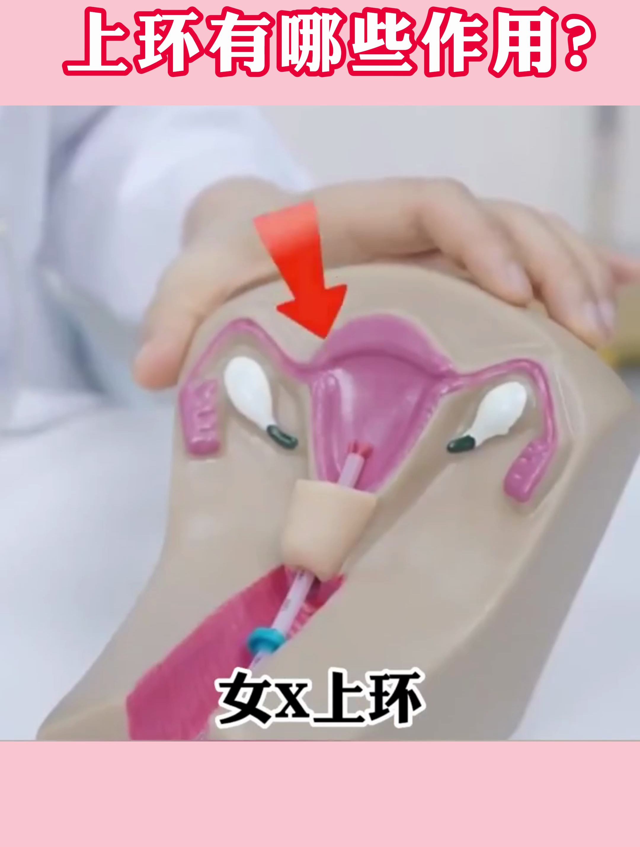 女性上环全过程,上环除了避孕还有哪些作用?