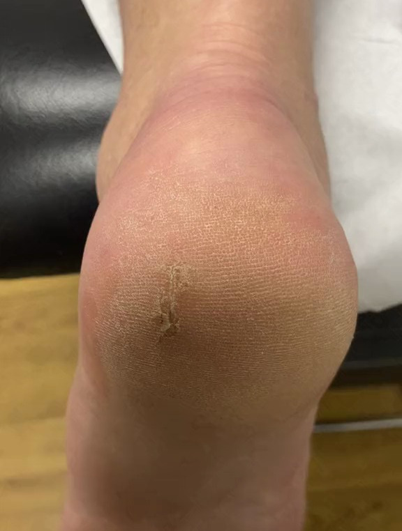 专业修脚,去除脚后跟老茧死皮,超解压-度小视