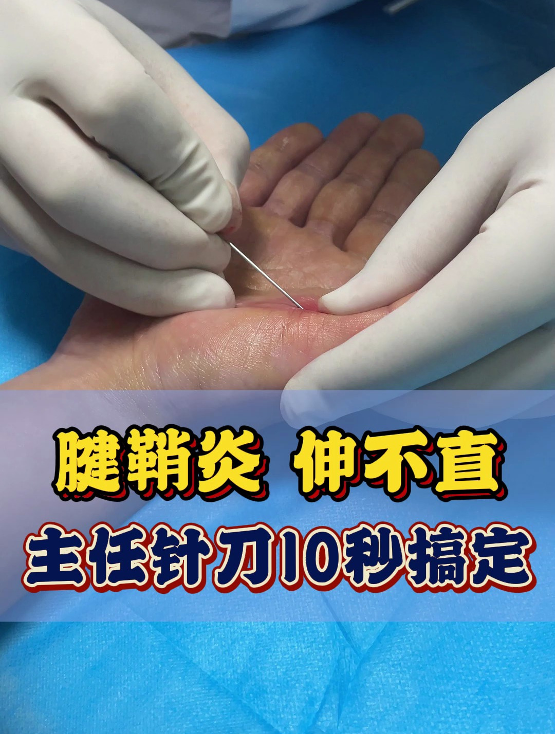 腱鞘炎伸不直怎么办?刘主任小针刀10秒搞定!