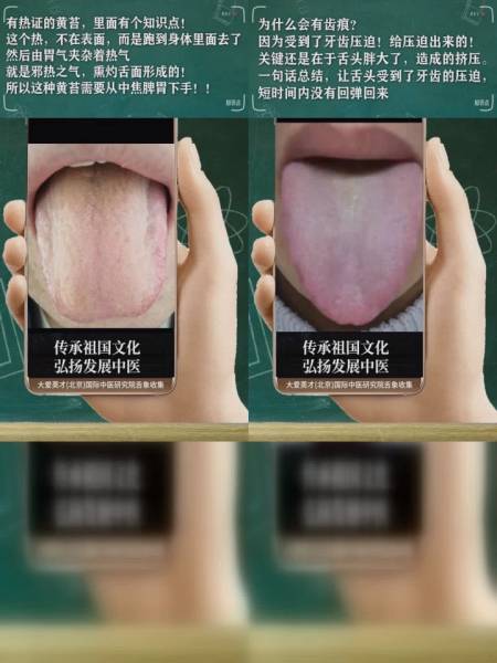 研究舌象舌头小舌脾湿肝肾阴虚阴虚阳亢
