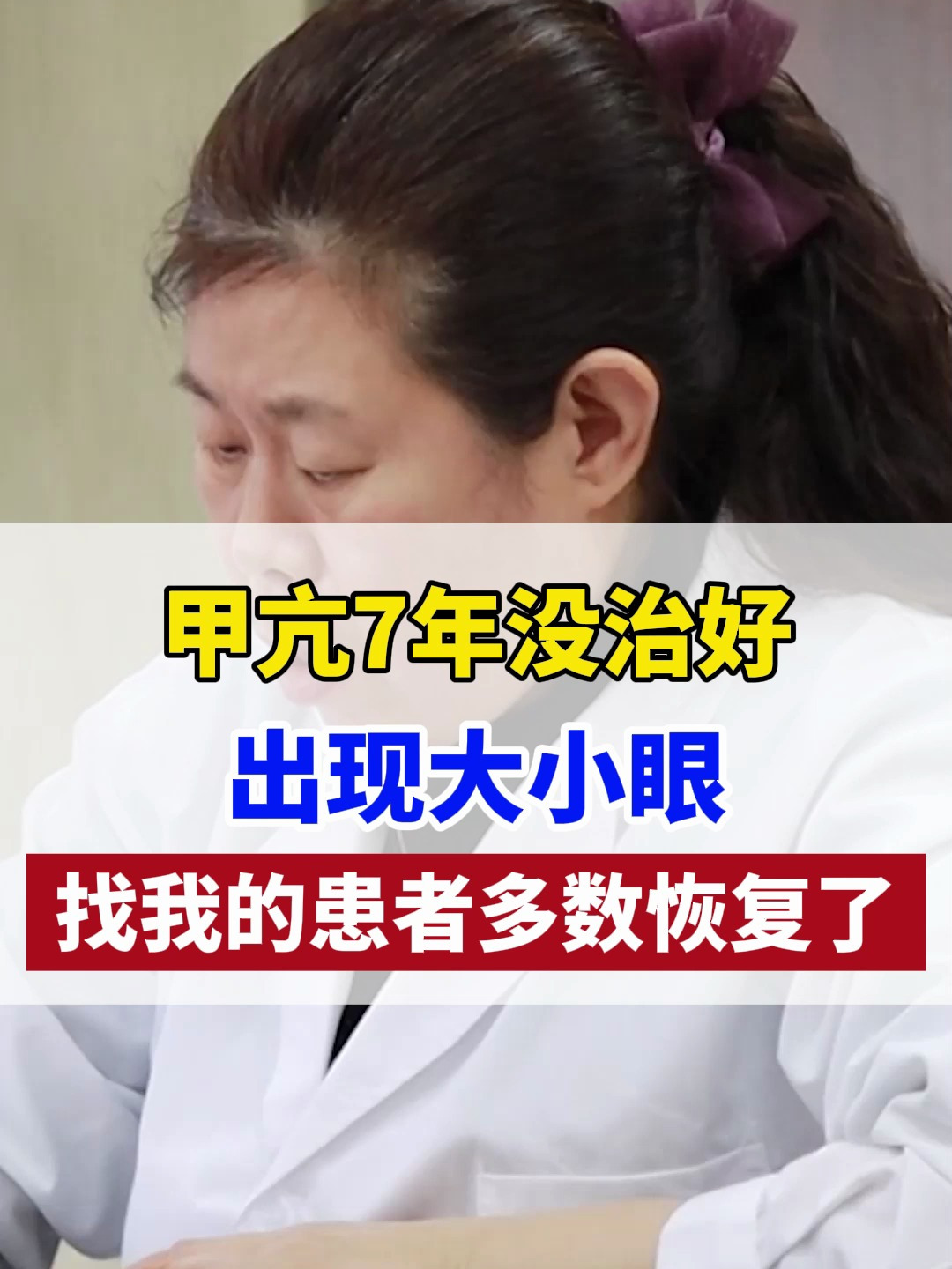 甲亢7年没治好出现大小眼找我的患者多数恢复了