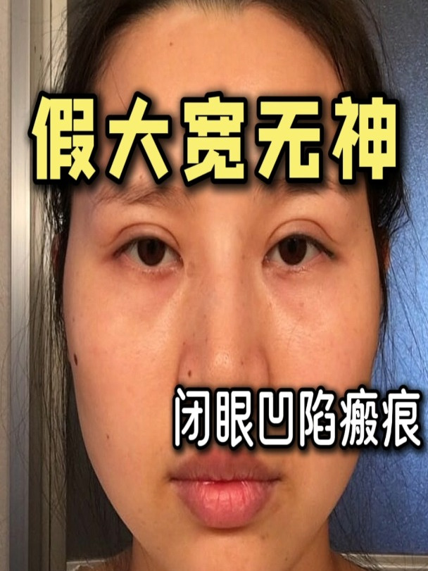 肉条感双眼皮会消吗图片