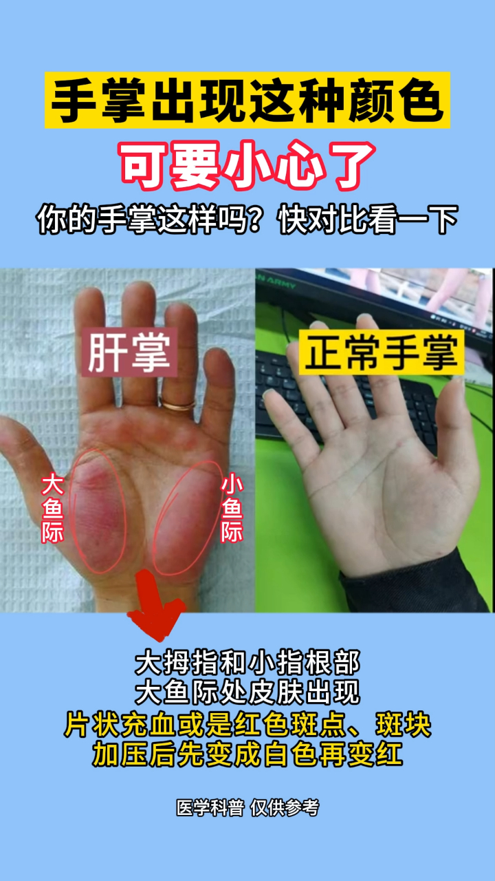 手掌出现这种颜色,要小心了