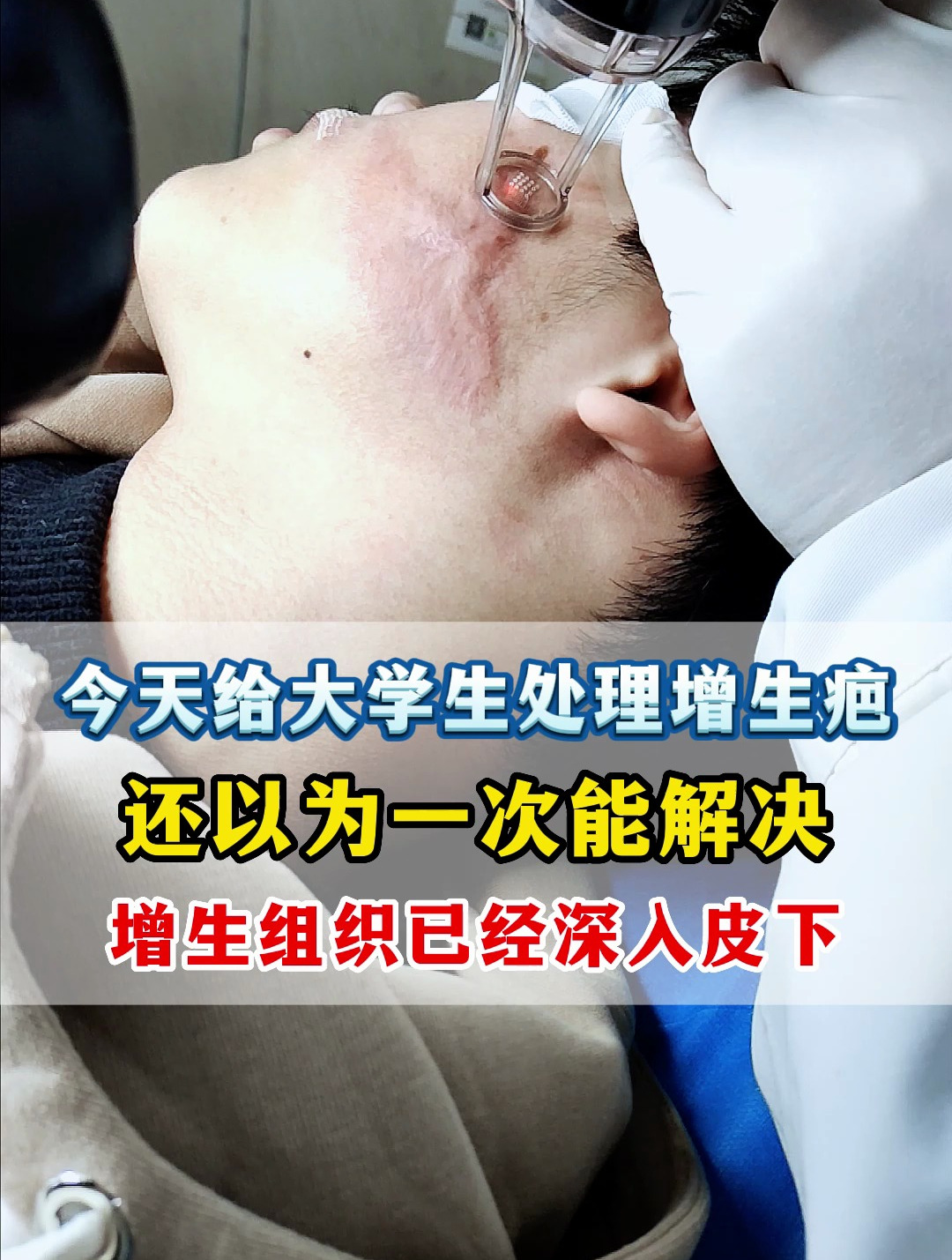 今天给大学生处理增生疤,本来还以为一次能解决-度小视