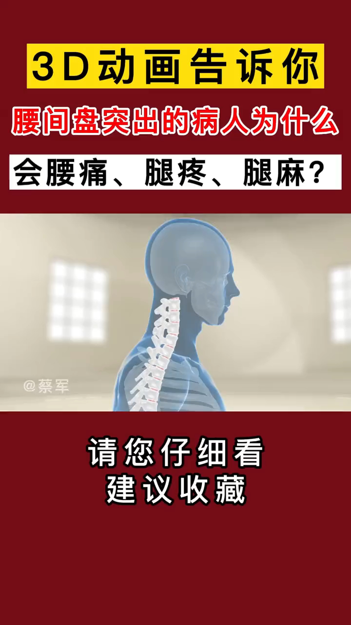 腰间盘突出的病人为什么会腰疼腿麻腿疼