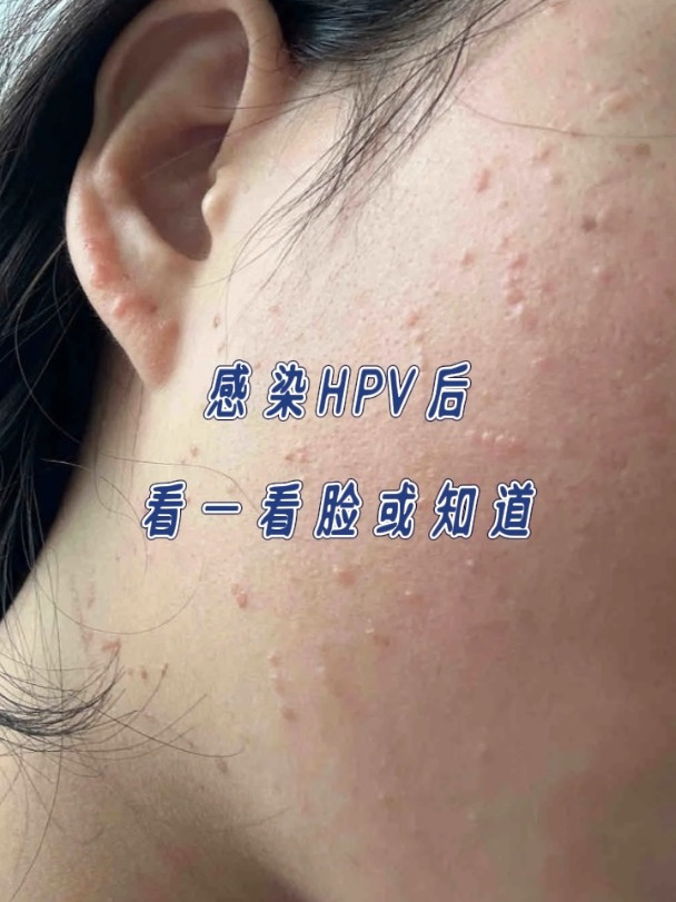 感染hpv后,看一看脸或明了
