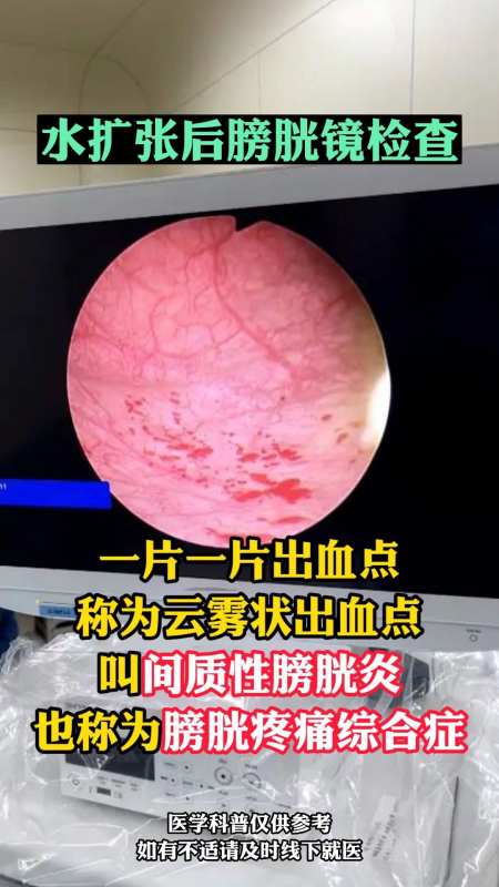 顽固性尿频,间质性膀胱炎,你是否存在?-度小视