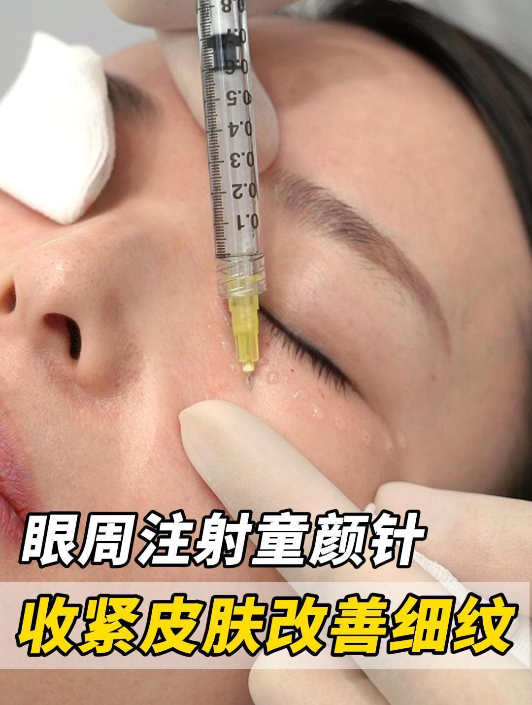 眼周童颜针注射,改善眼周细纹