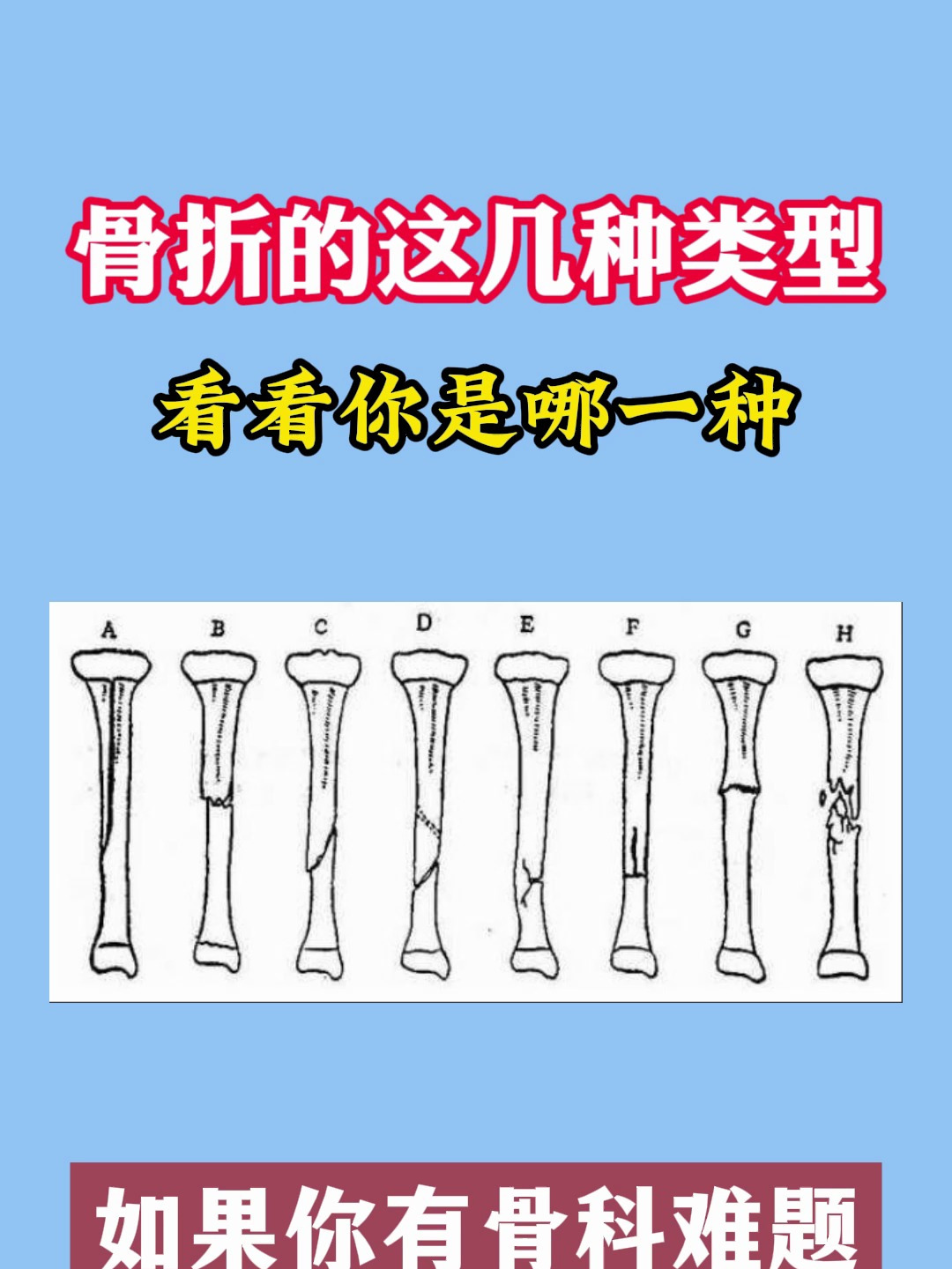 常见的骨折8种类型,你属于哪一种?