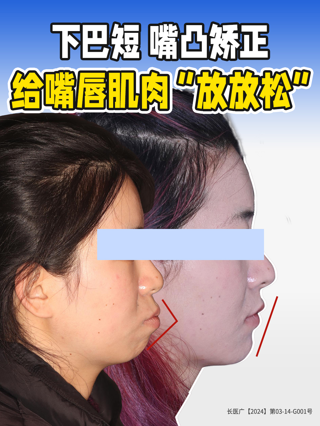 钝感嘴凸矫正逆旋导下巴气质变清冷