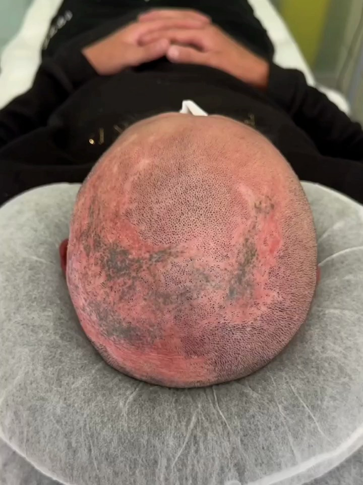 纹发失败案例:贵不一定最好,但也有贵的道理!