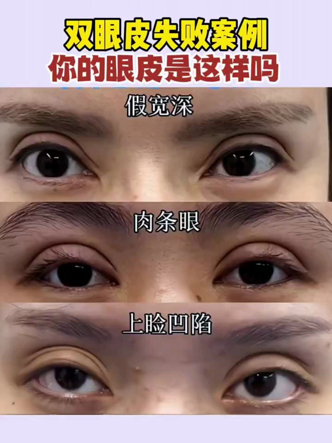 双眼皮失败案例!快来看看你的是不是这个状况