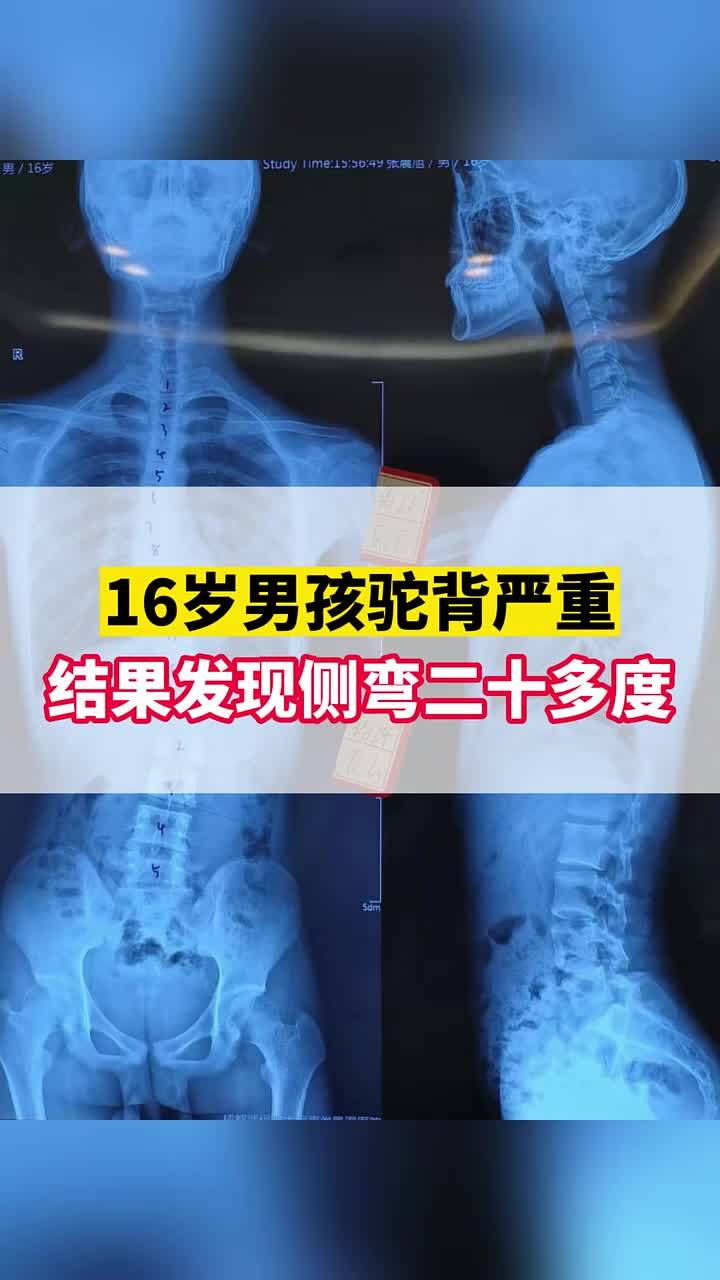 16岁男孩平时弯腰驼背体态不好