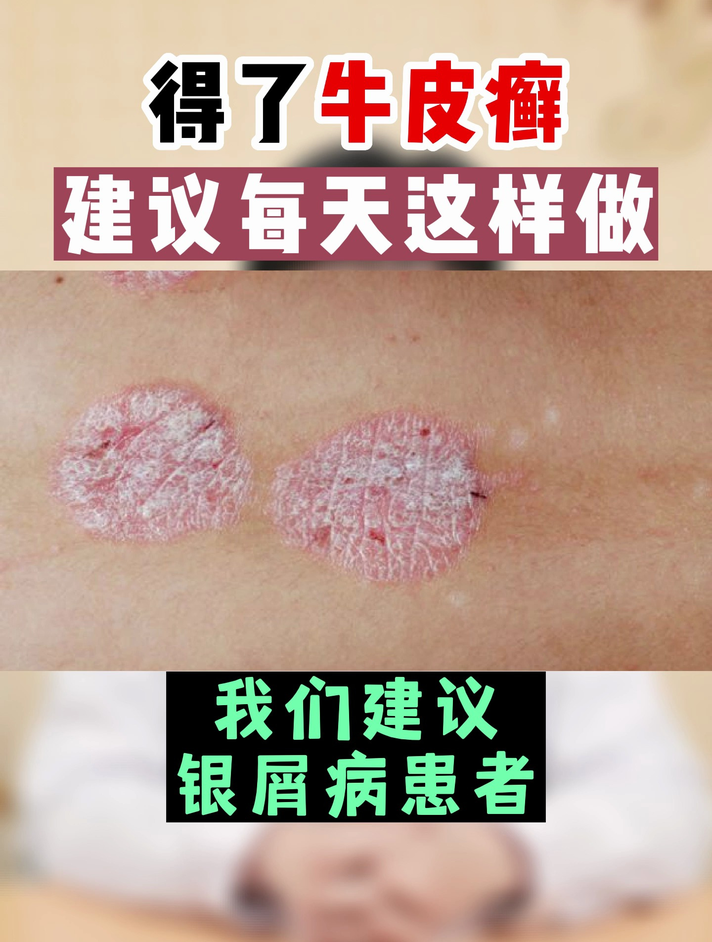得了牛皮癣,建议每天做这两件事
