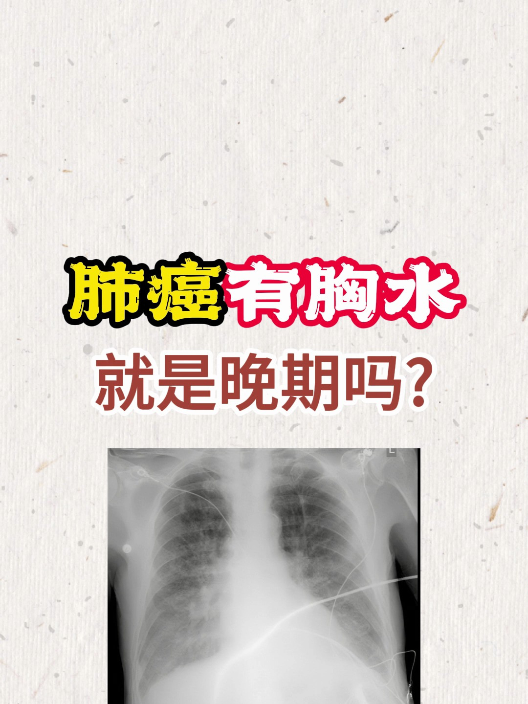 肺癌发现肺部有胸水,就是晚期吗?该如何正确判断