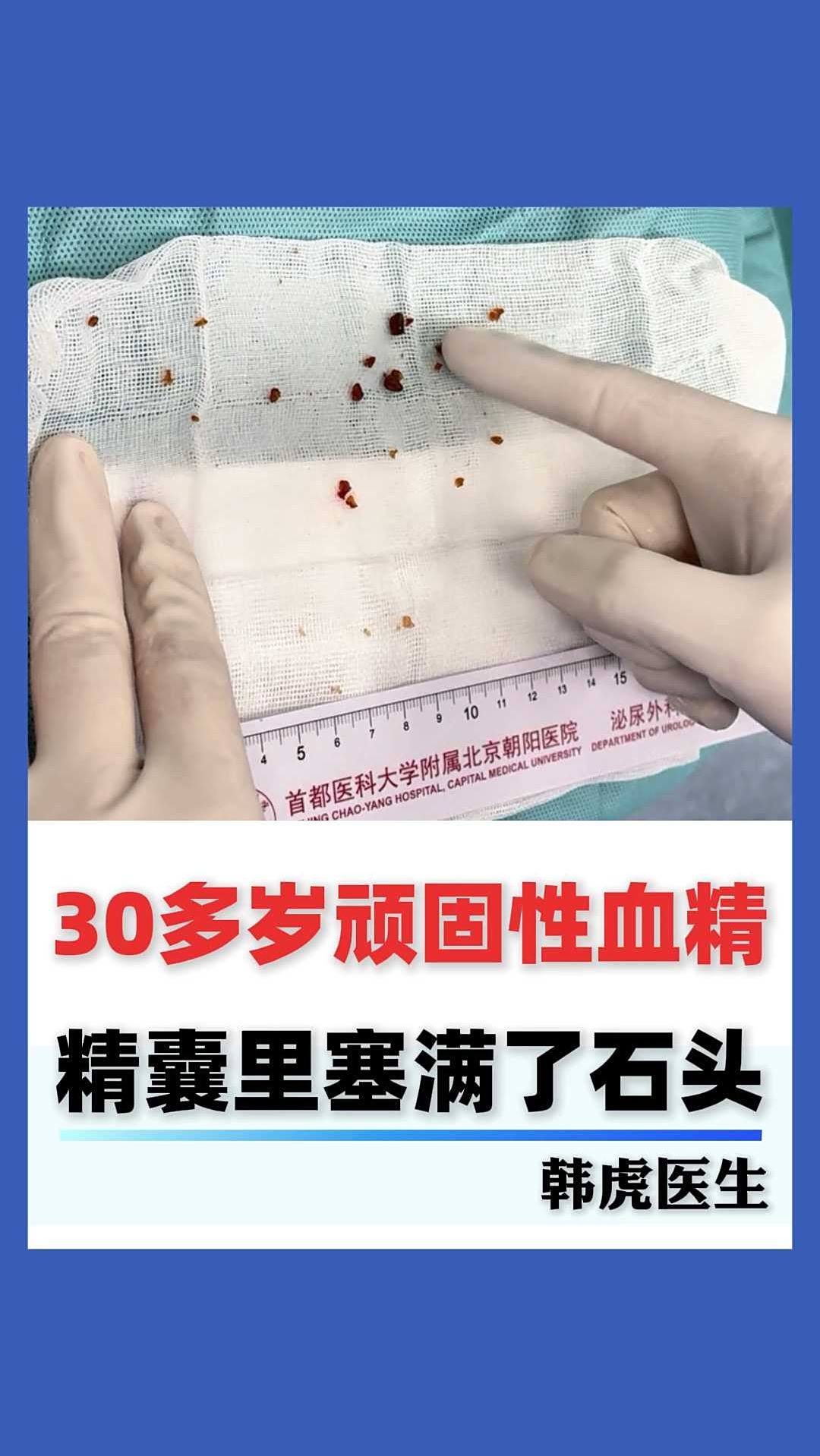 30多岁顽固性血精,精囊里塞满了石头