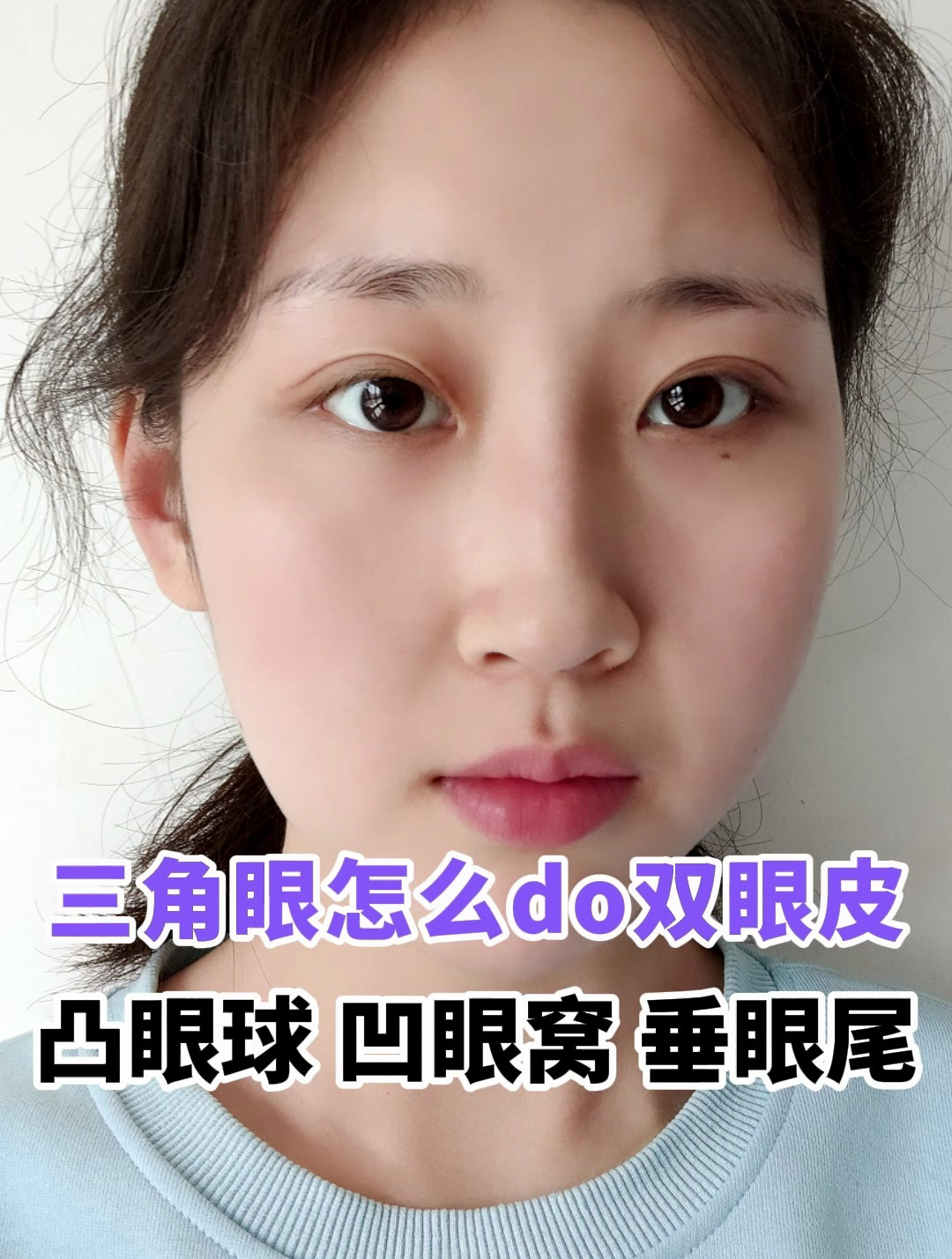 凸眼球凹眼窝垂眼尾这种眼睛怎么做双眼皮?