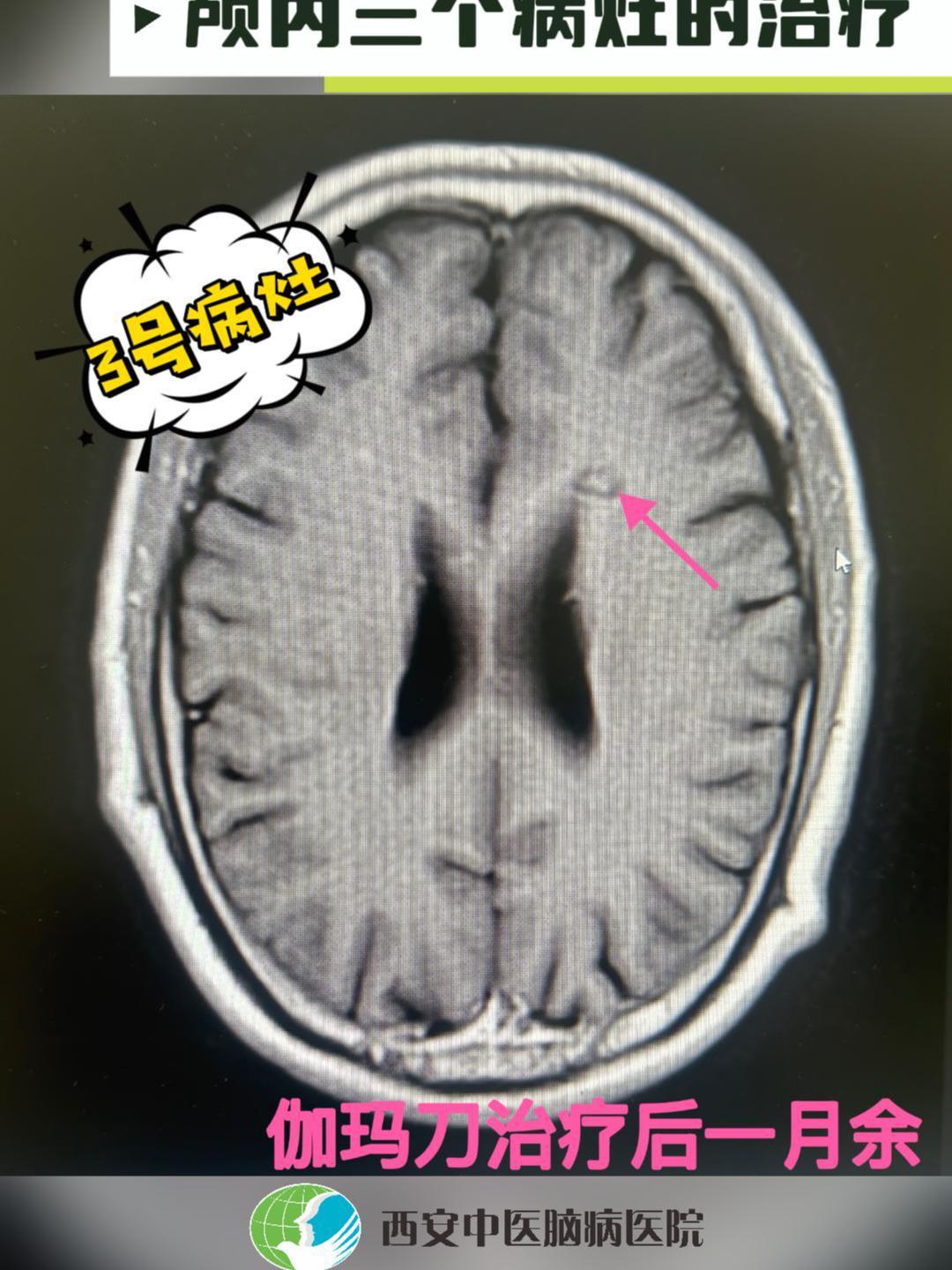 恶性肺癌脑转移患者治疗病例