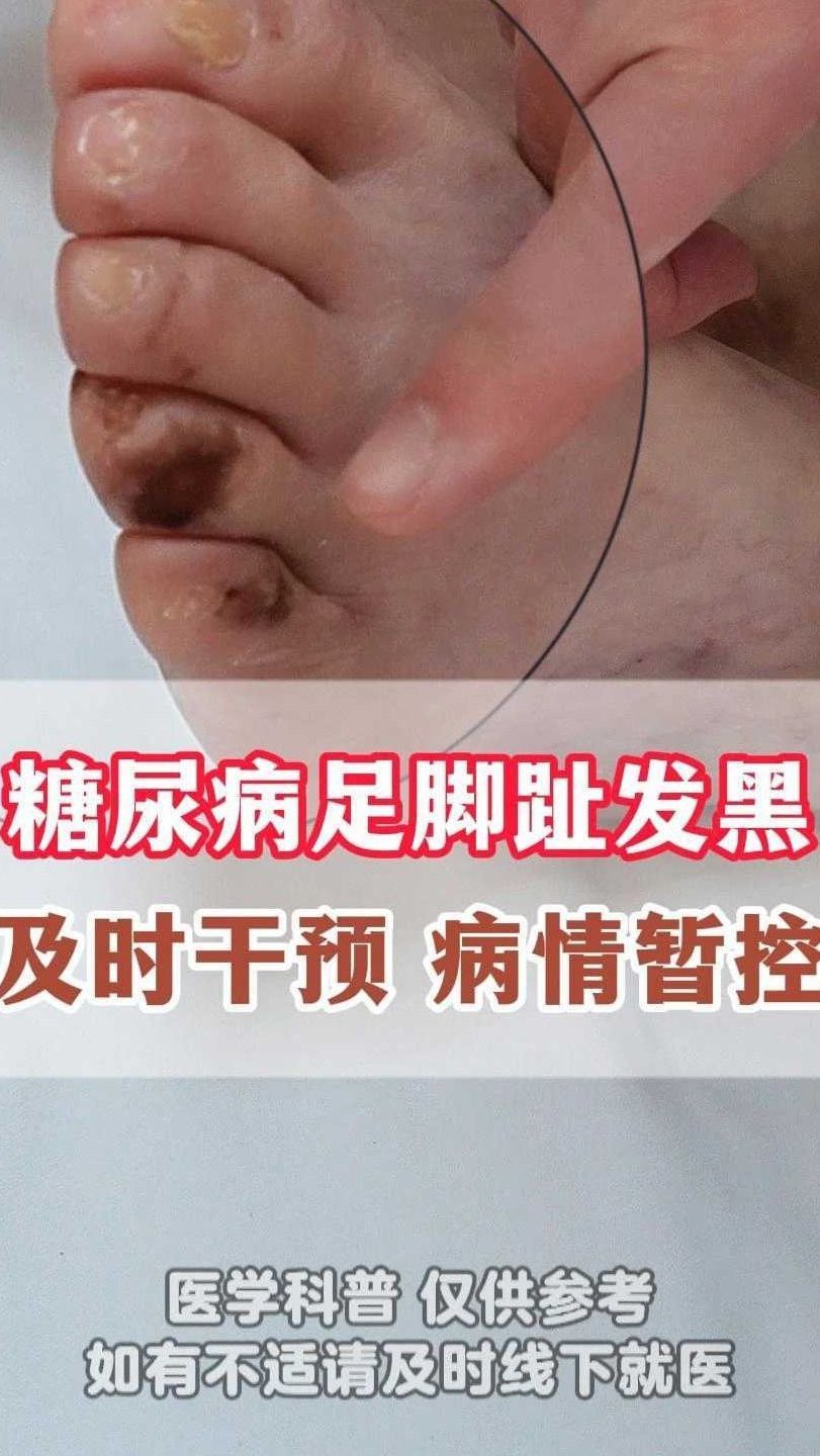 糖尿病足脚趾发黑