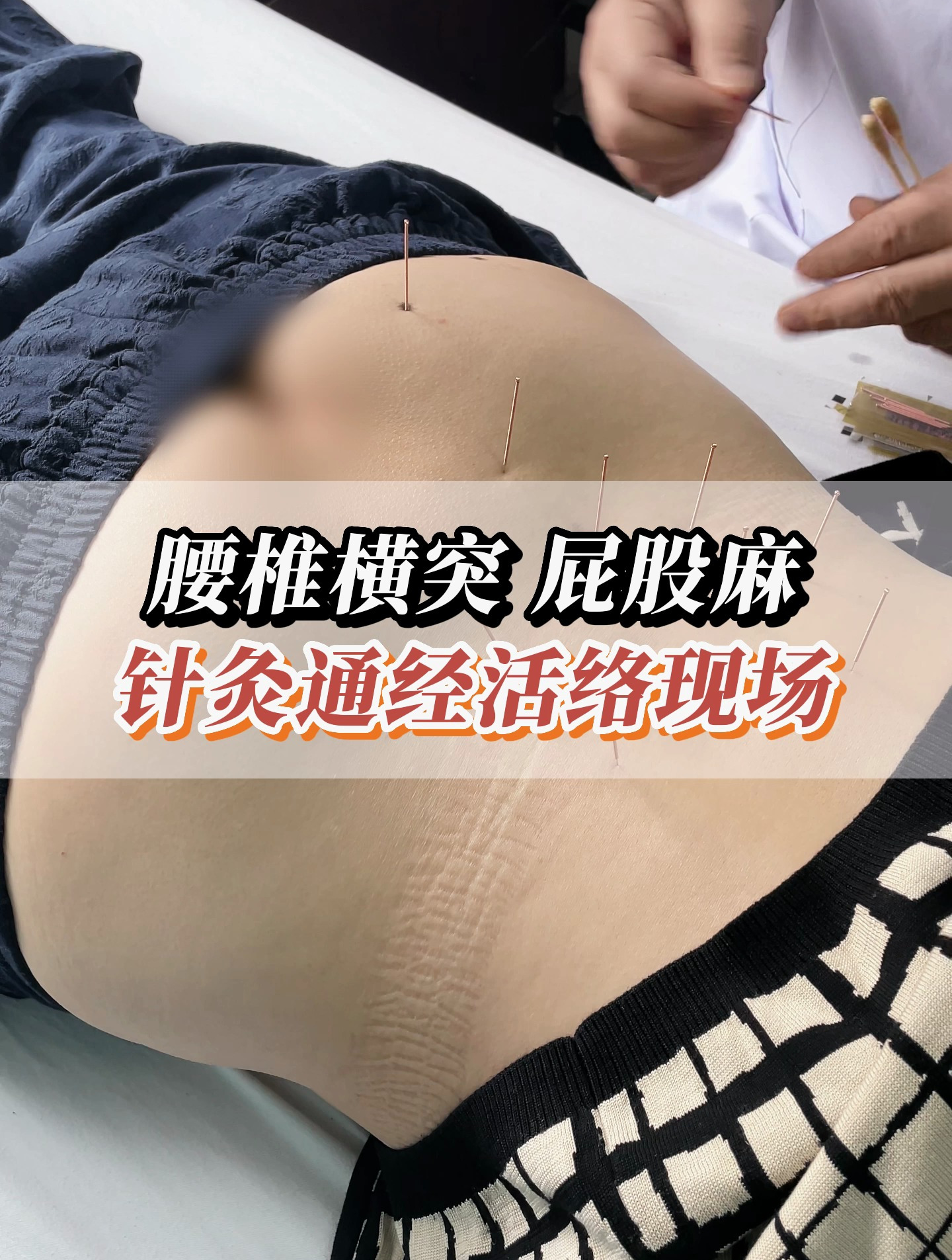 腰椎横突 屁股麻,针灸治疗有酸麻胀痛的感觉就对了