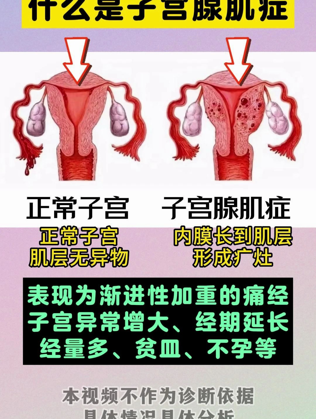 一张图看懂什么是子宫腺肌症