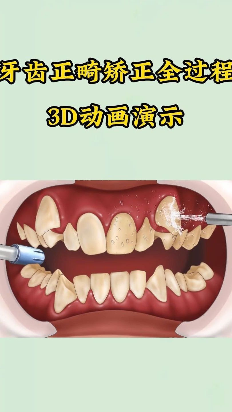 牙齿正畸矫正全过程3d动画演示