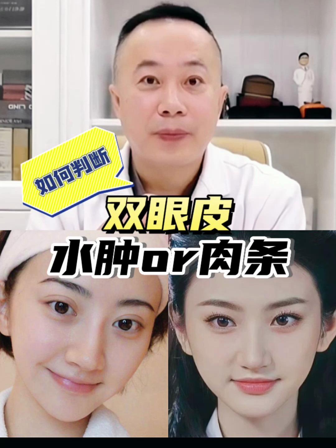 如何判断,双眼皮水肿还是肉条?