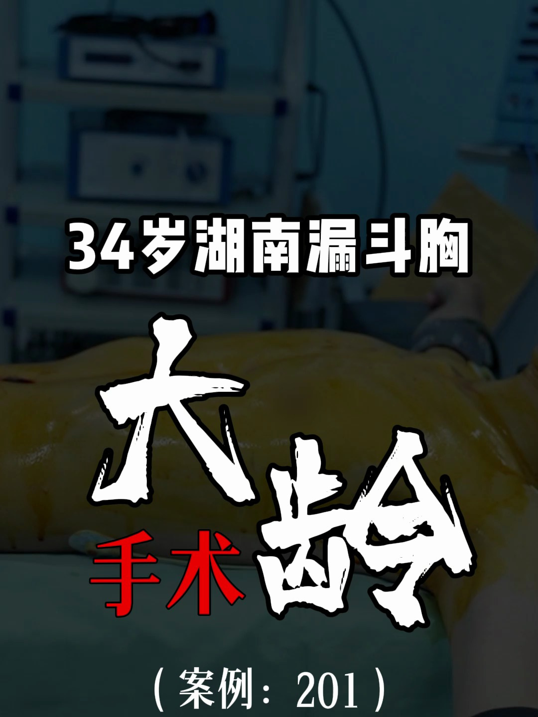 30多岁了漏斗胸还能进行手术吗,今天就是一例,年龄不是界限