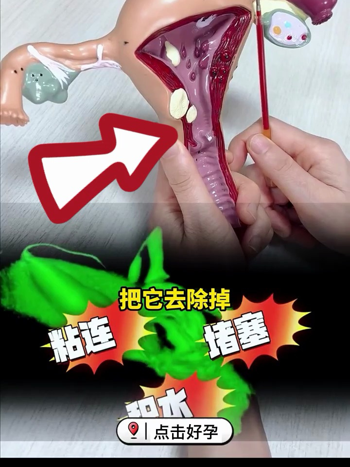 输卵管结扎常在哪几个部位?复通又是怎么回事?一次性讲清楚