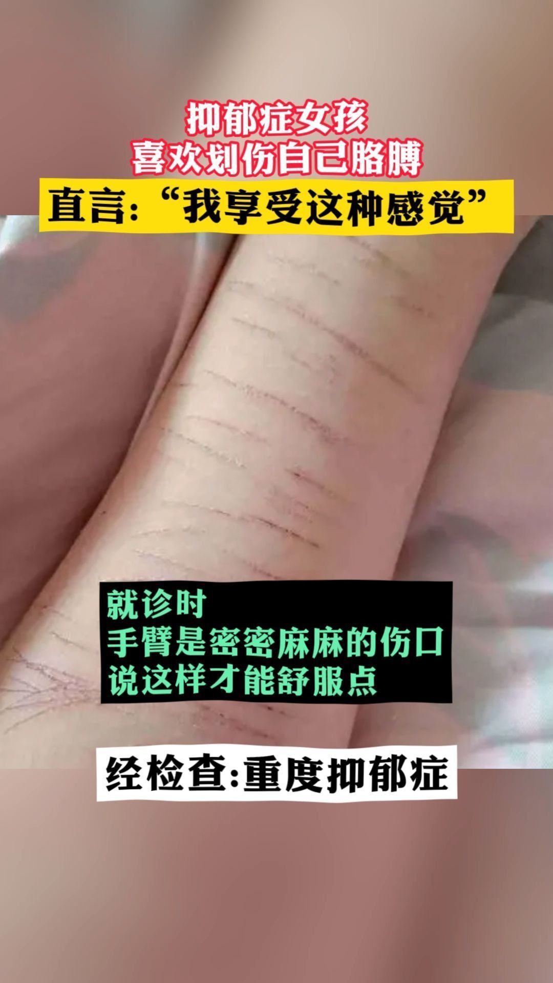 抑郁症女孩喜欢划伤自己胳膊,直言"我享受这种感觉"