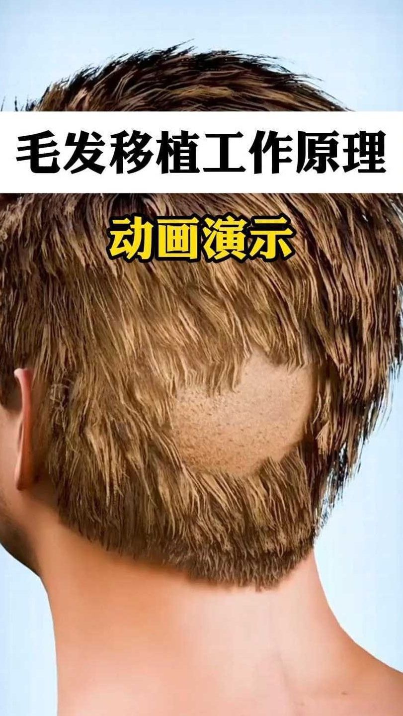 毛发移植的_毛发移植的手术费用