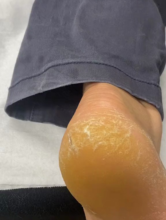 专业修脚,去除脚后跟老茧死皮,超解压-度小视