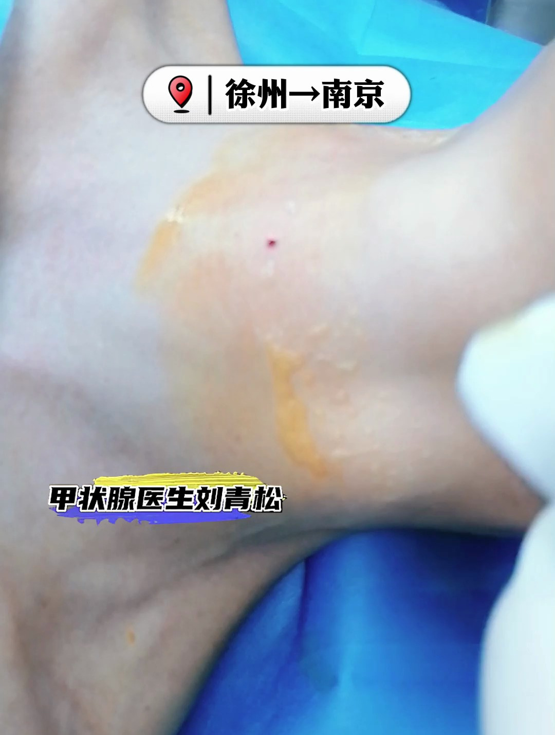 陈先生查出甲状腺结节3类,结节靠近峡部,位置不好,担心会癌变
