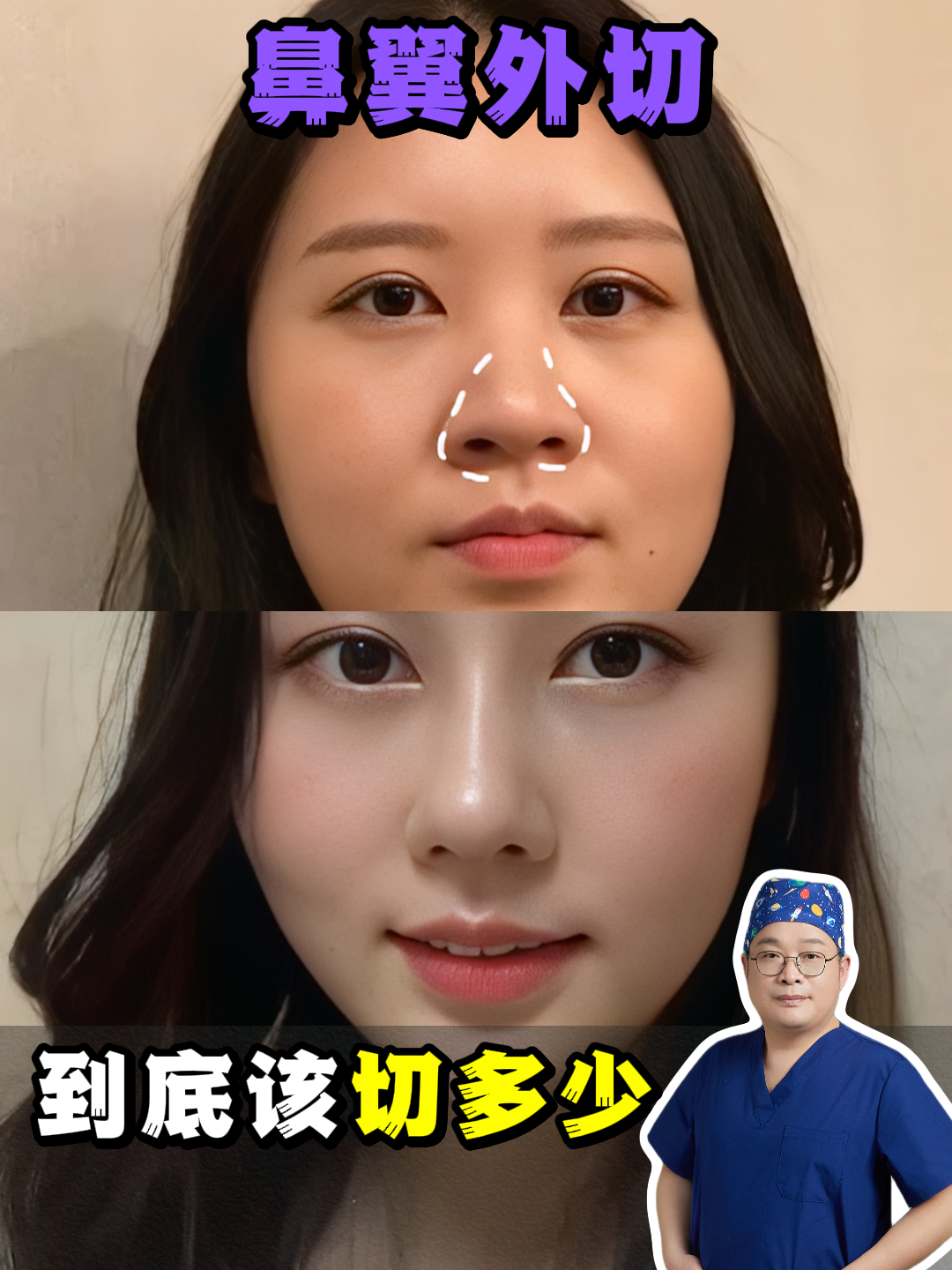 鼻翼外切该切多少?鼻翼大的人视频要认真看完