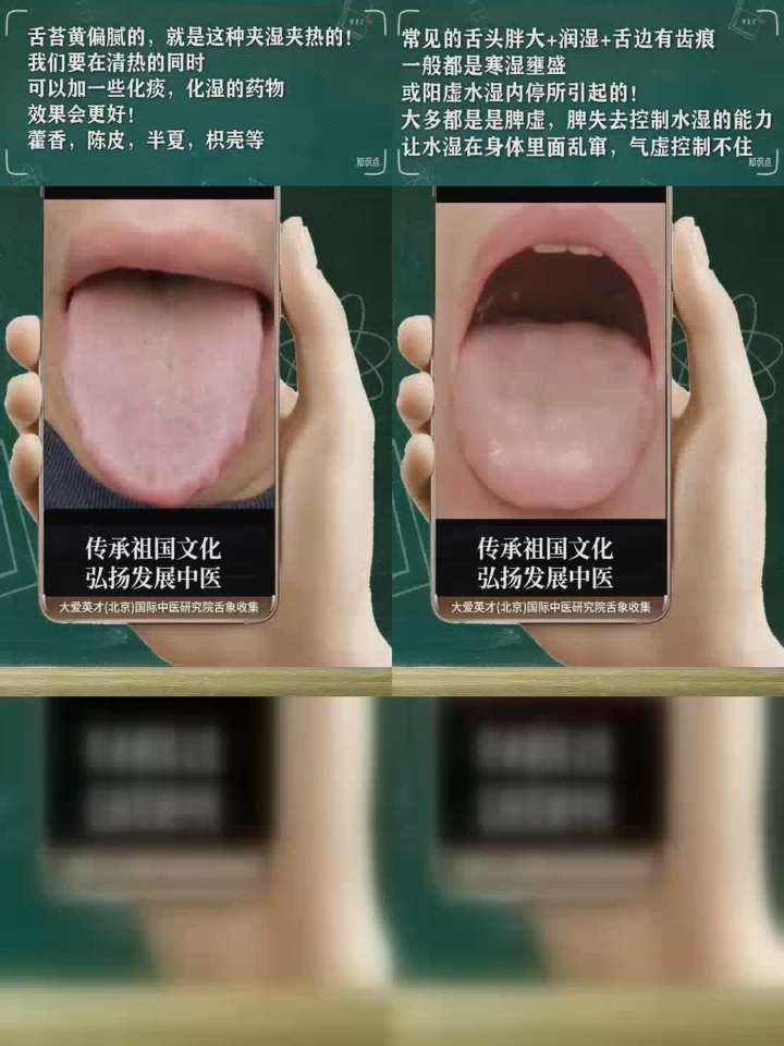 研究舌象舌苔灰黑舌二火不潜思虑过度心血失养