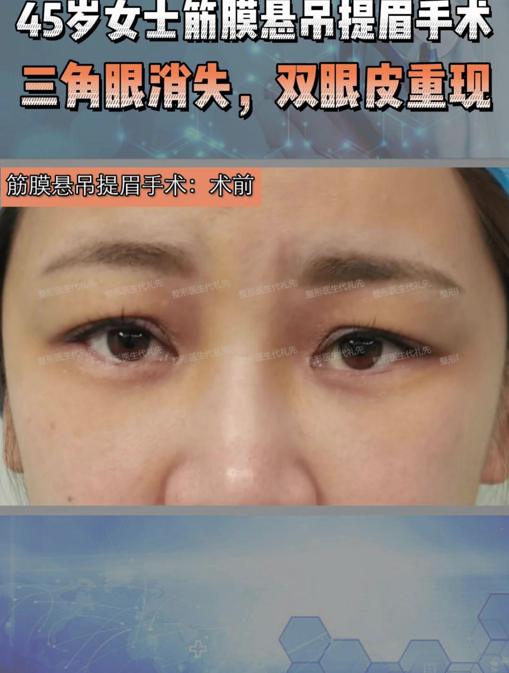 45岁女士筋膜悬吊提眉手术三角眼消失双眼皮重现