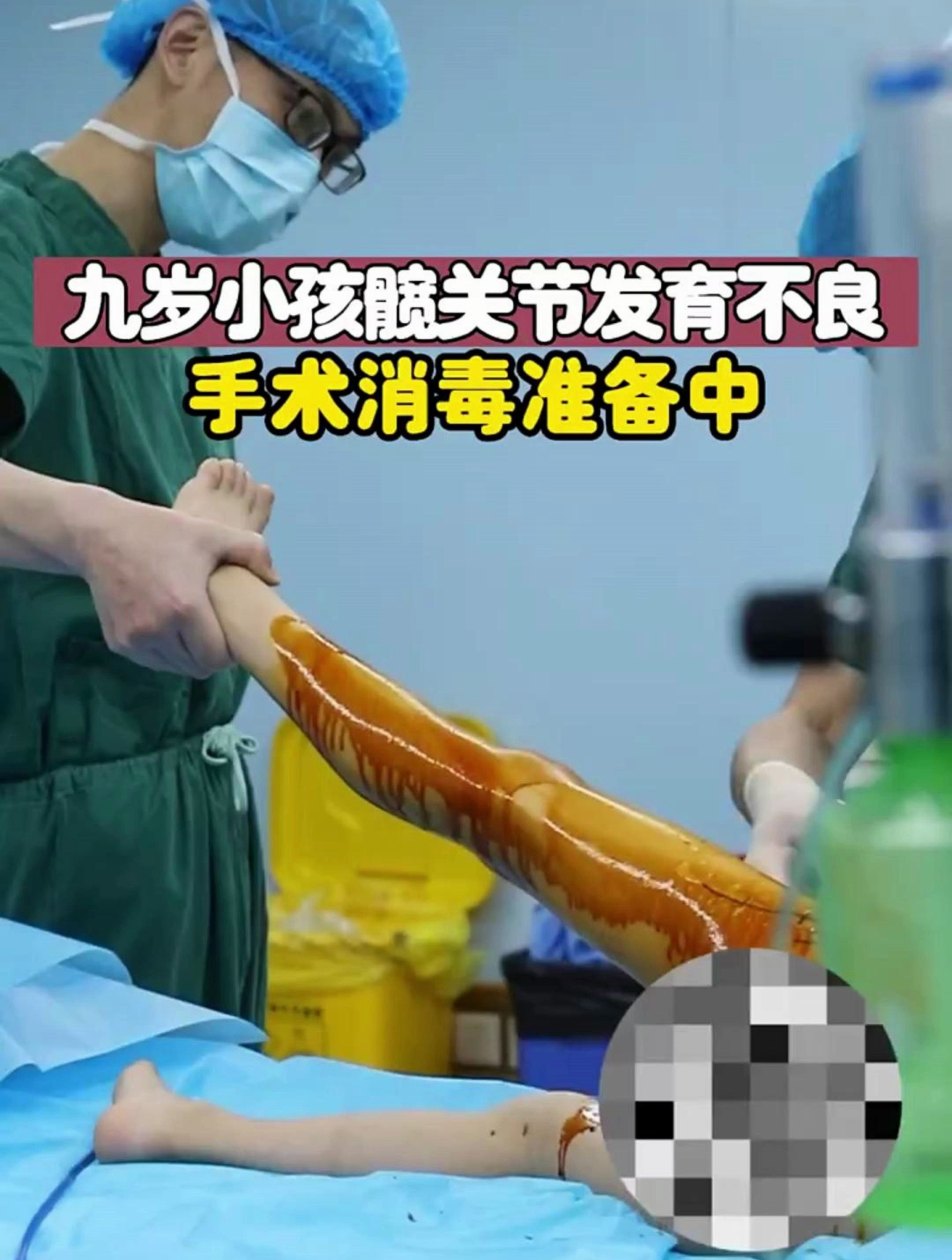 九岁小朋友髋关节发育不良,准备手术中