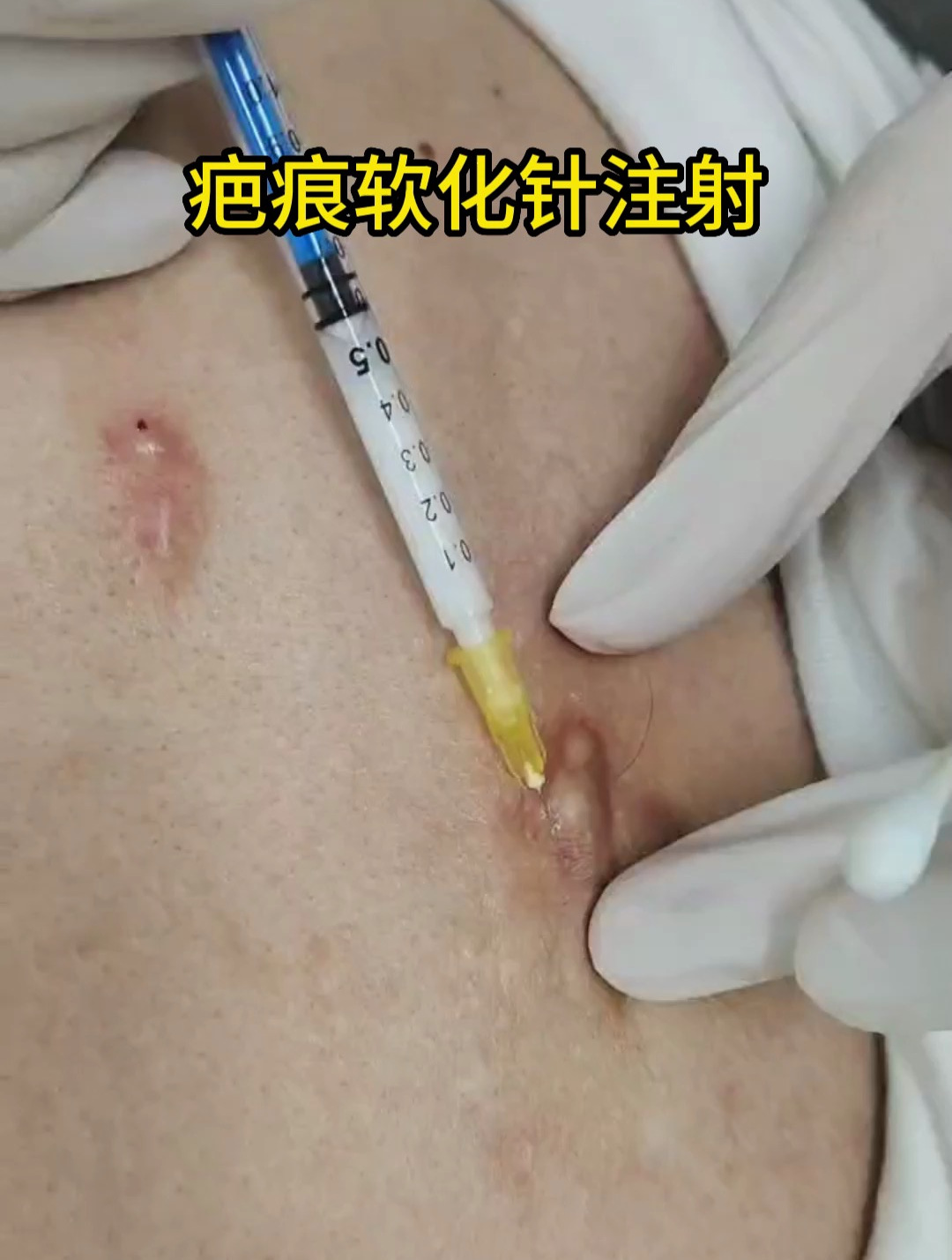疤痕疙瘩注射治疗