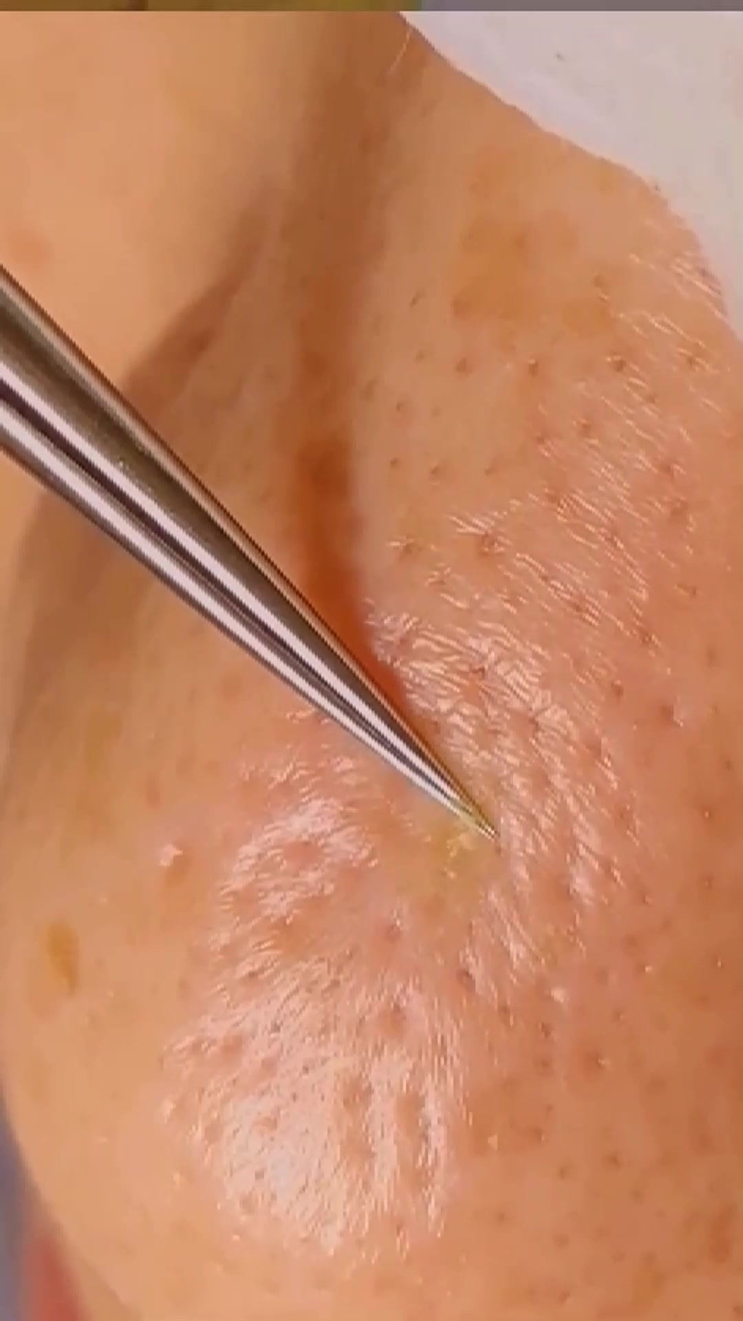 用手挤黑头容易引起皮肤发炎,亲测这款去黑头神器