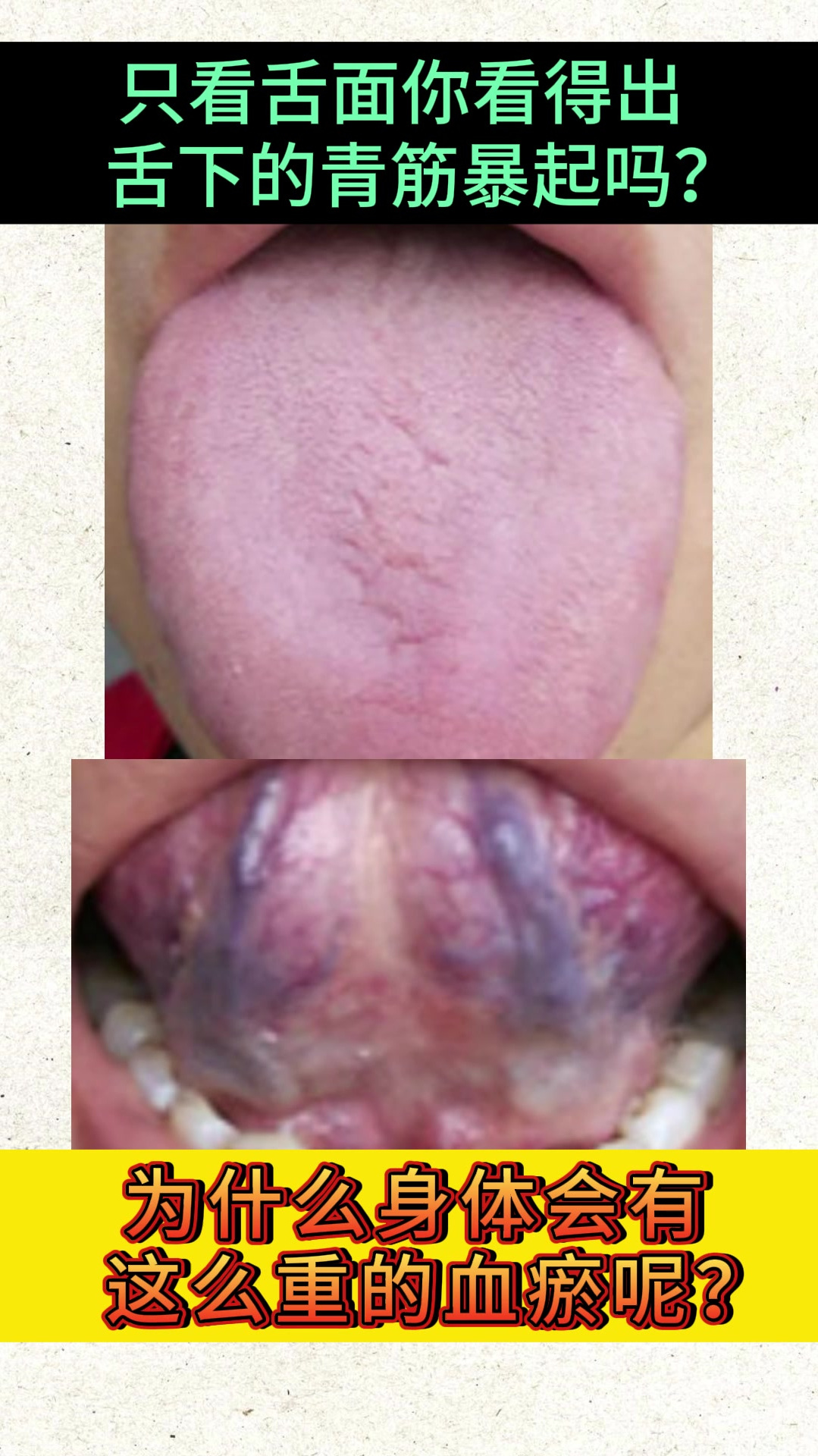 舌下青筋暴起,为什么会有这么重的血瘀?
