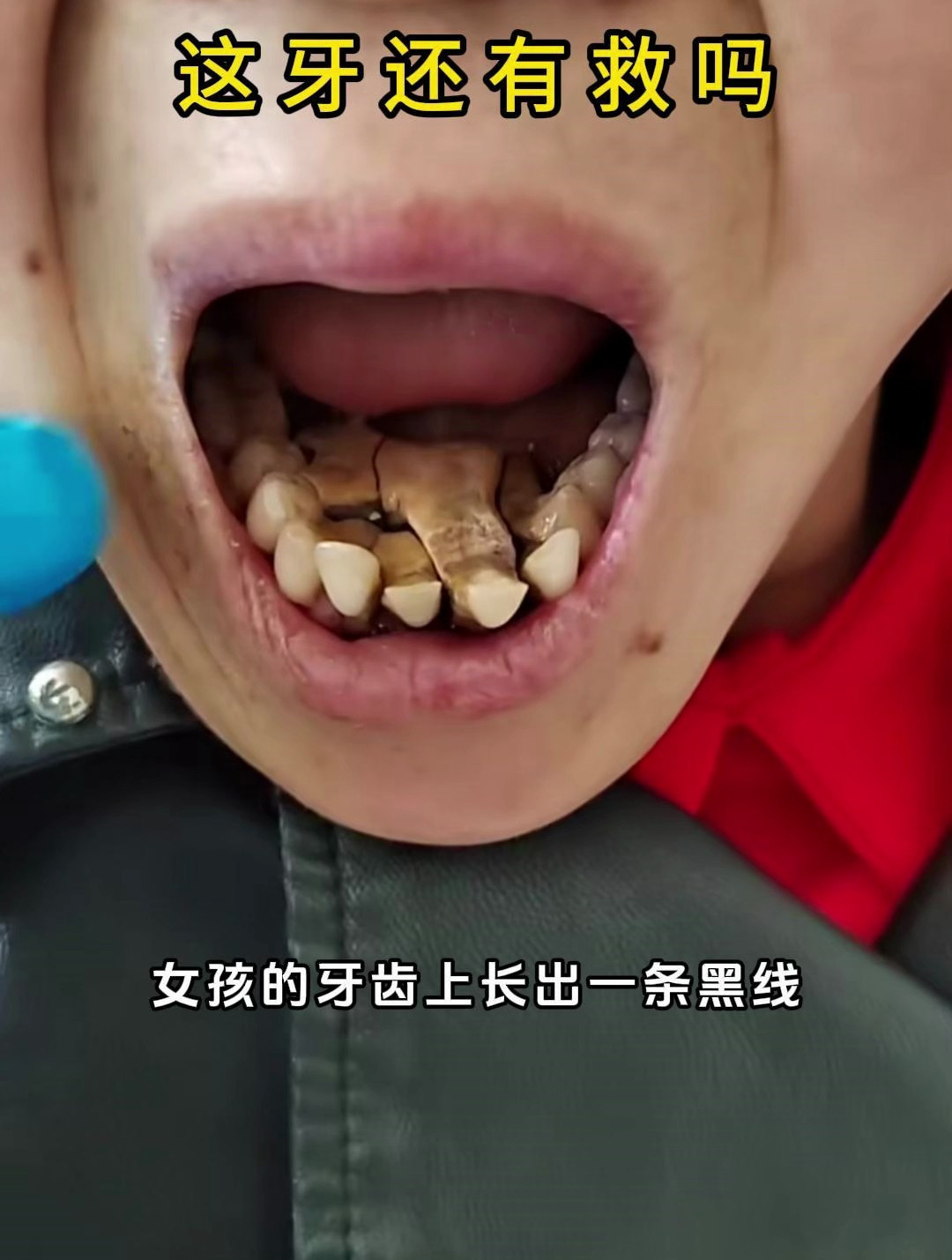 为什么牙缝里的东西很臭