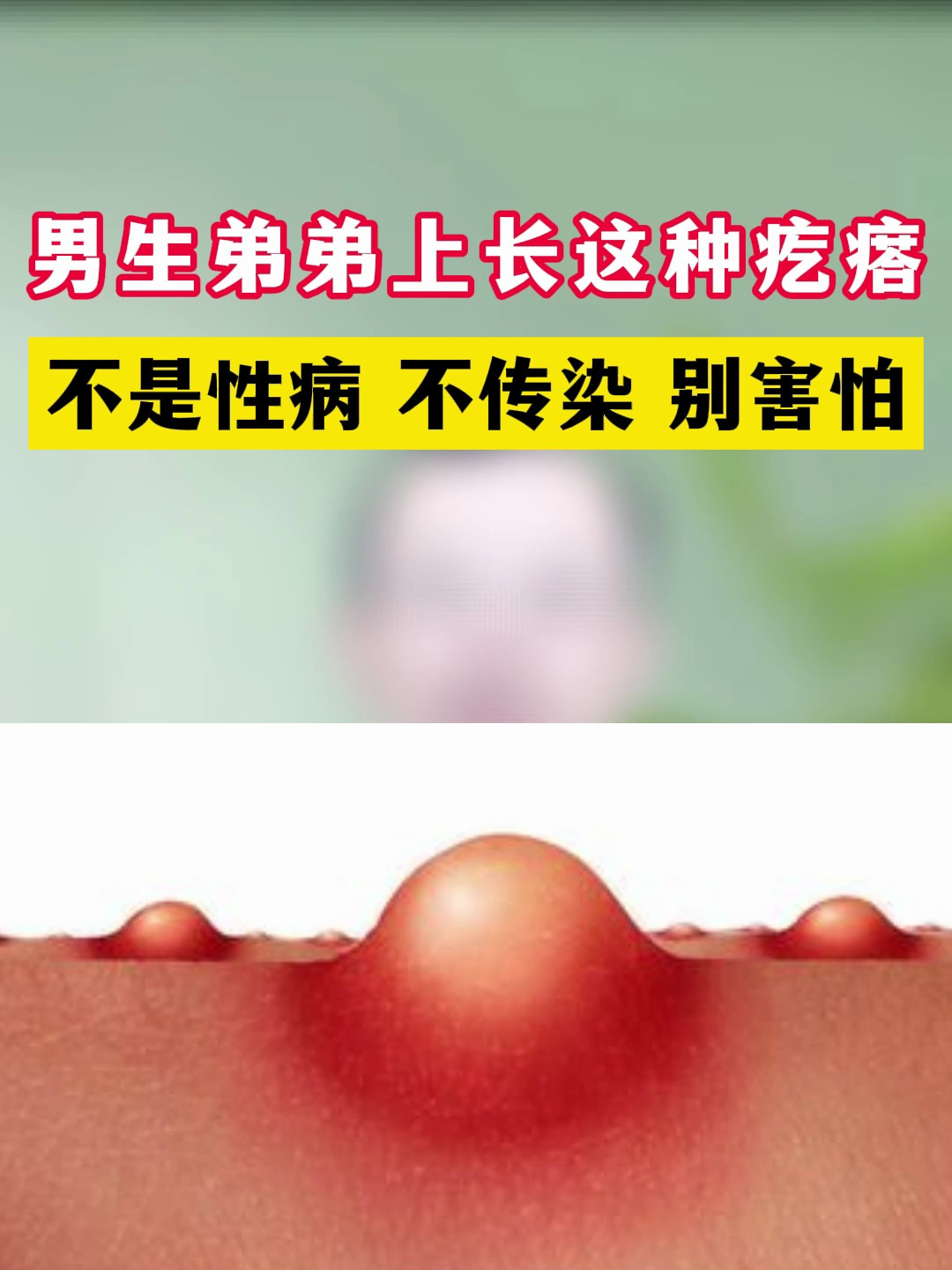 男生弟弟上长这种疙瘩 不是性病 不传染 别害怕
