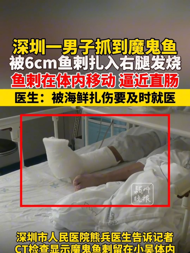 男子被6cm魔鬼鱼刺扎入右腿发烧 鱼刺在体内移动 已逼近直肠