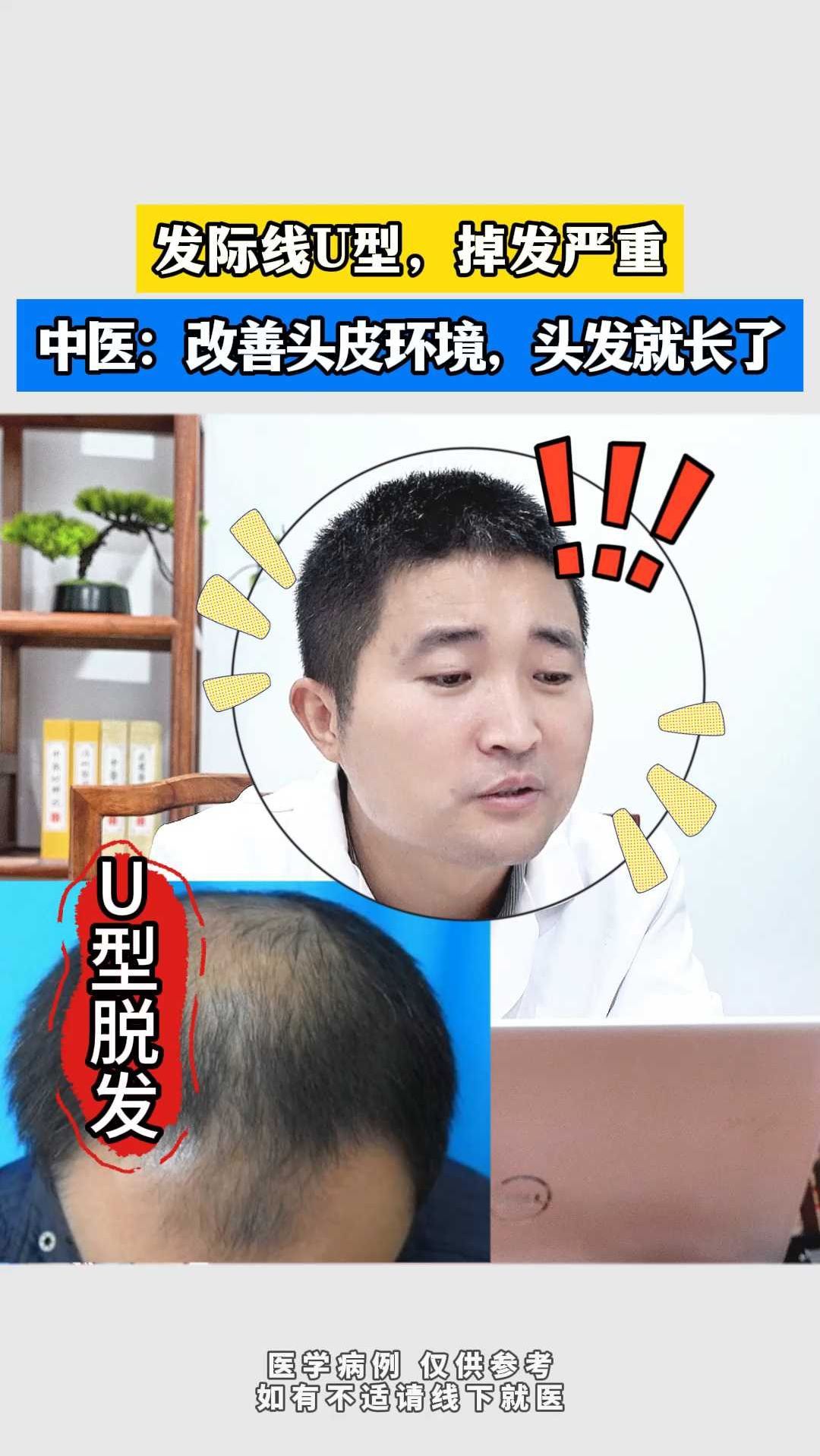 发际线u型,掉发严重?要改善头皮环境