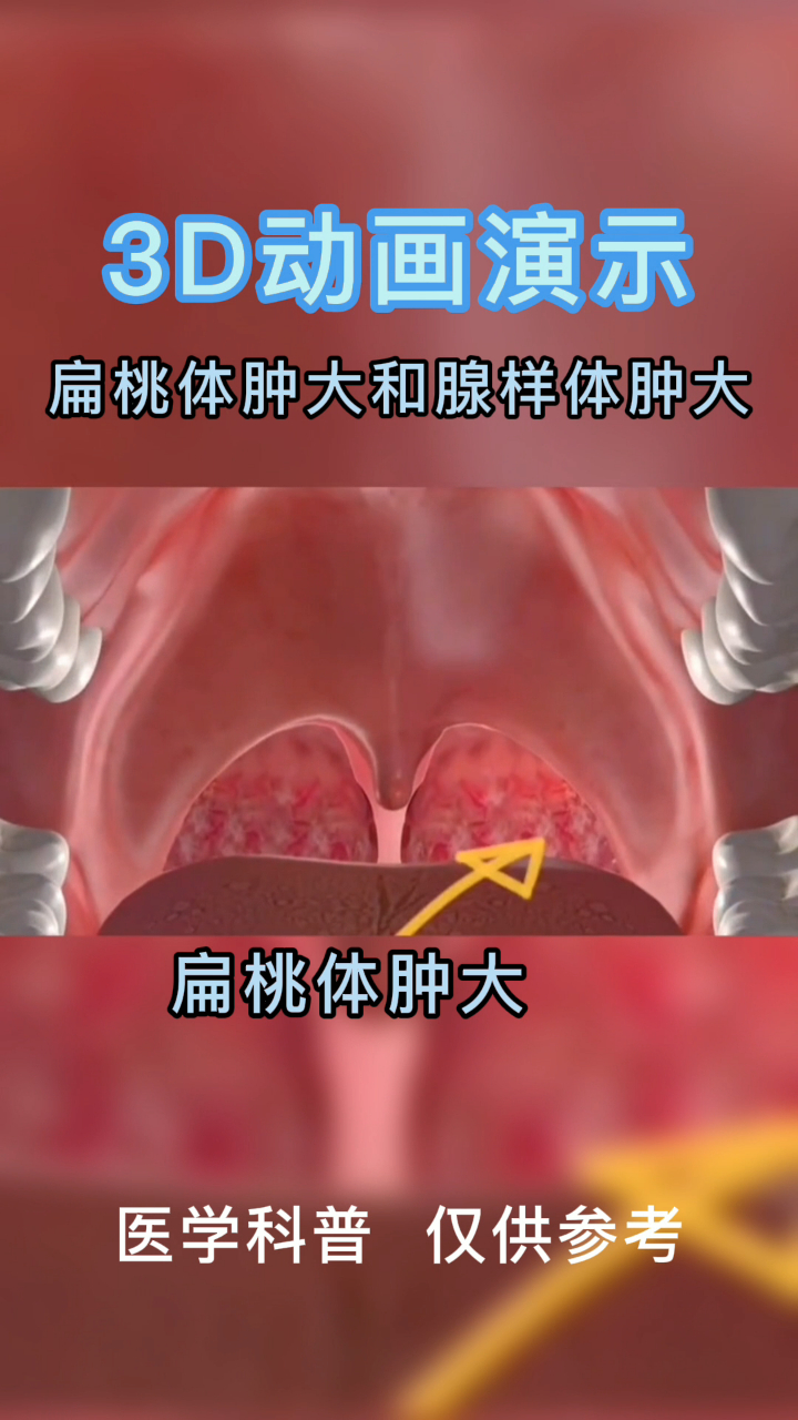 3d動畫演示扁桃體腫大和腺樣體腫大