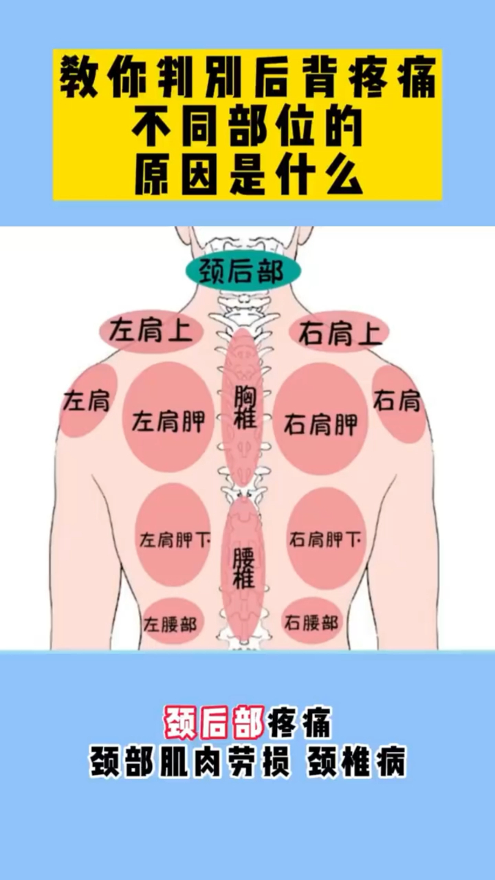 一张图告诉你后背不同位置疼痛代表着什么症状