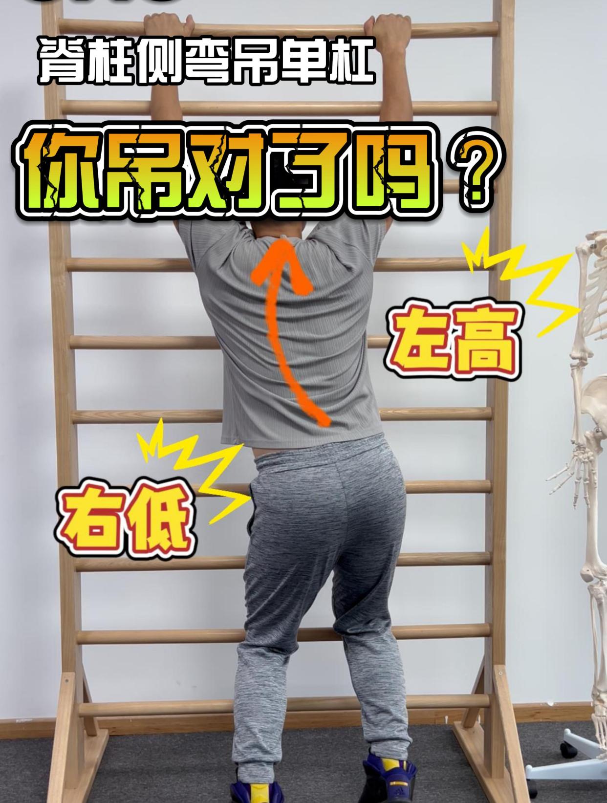 脊柱侧弯吊单杠,你吊对了吗?
